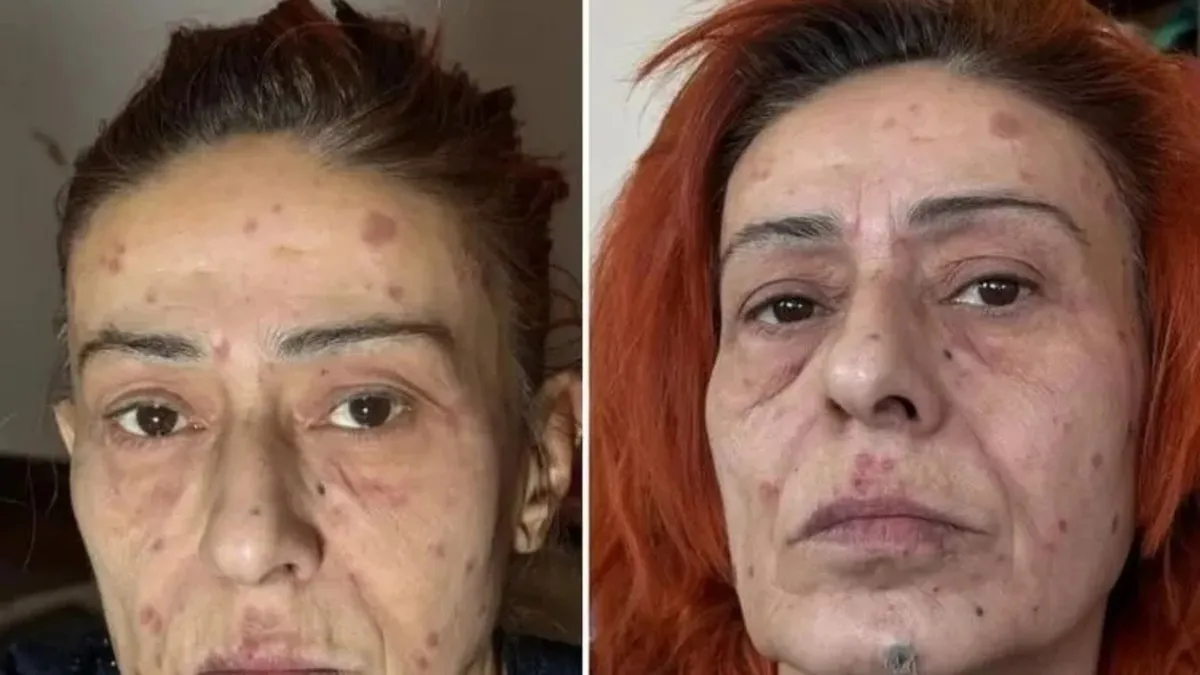 Saç boyası yüzünü yakmıştı! Şarkıcı Yıldız Tilbe son sağlık durumu hakkında bilgi verdi!